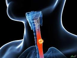 Neglected role of hookah and opium in gastric carcinogenesis: A cohort study on risk factors and attributable fractions